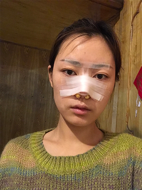 天津伊美爾超肋鼻綜合案例一周效果圖