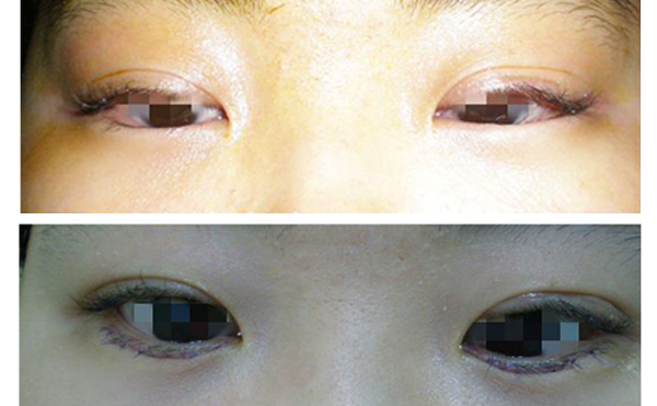 眼瞼內(nèi)翻什么意思？眼瞼內(nèi)翻怎么辦？