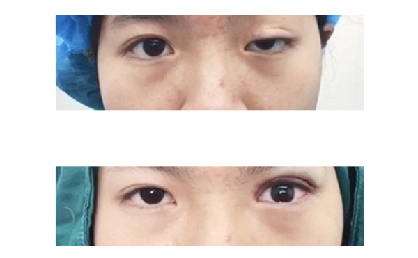 大小眼是什么原因造成的?大小眼怎么改善?