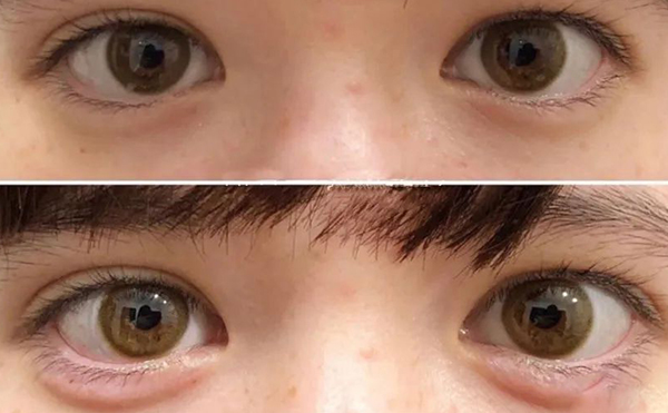 玻尿酸豐臥蠶效果是永久的嗎?術(shù)后有什么風(fēng)險?