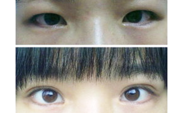 埋線雙眼皮能去腫眼泡嗎?可以維持多久?