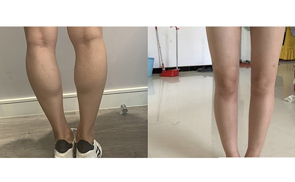 瘦腿針和吸脂哪個好？