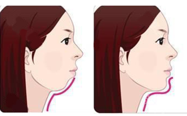 注射墊下巴的方式好嗎？