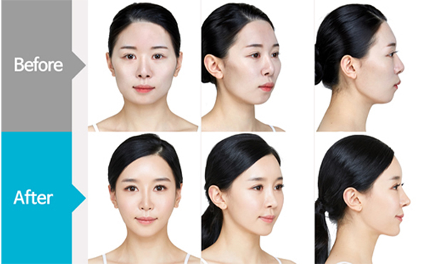 改臉型手術(shù)哪家好？