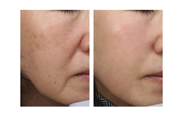 彩光嫩膚適合哪些人？