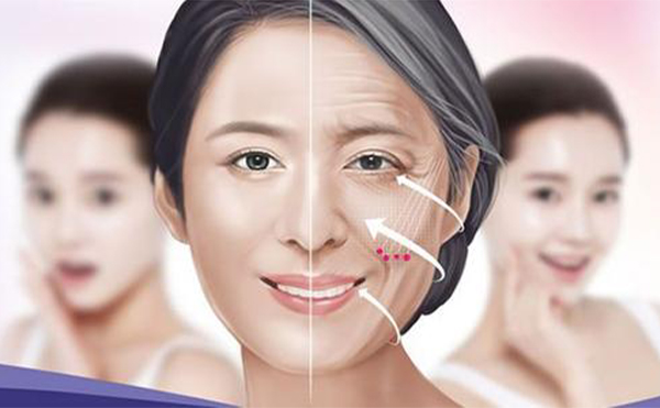 什么是埋線提升？