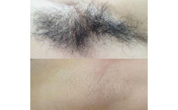 激光脫腋毛疼嗎？