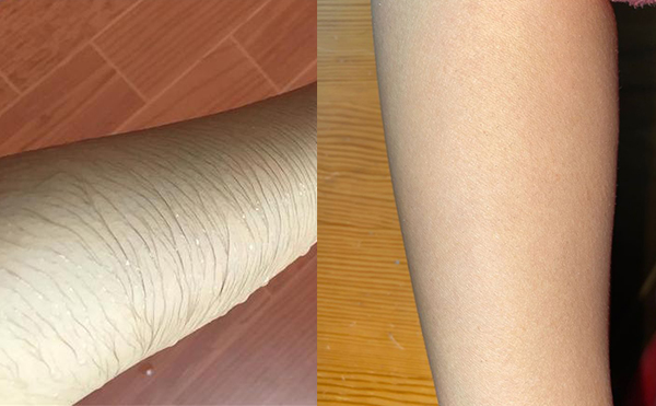 冰點(diǎn)手臂脫毛