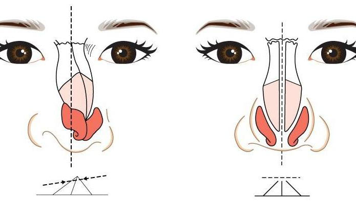 鼻子歪矯正大約多少錢？鼻子歪矯正恢復期多久？
