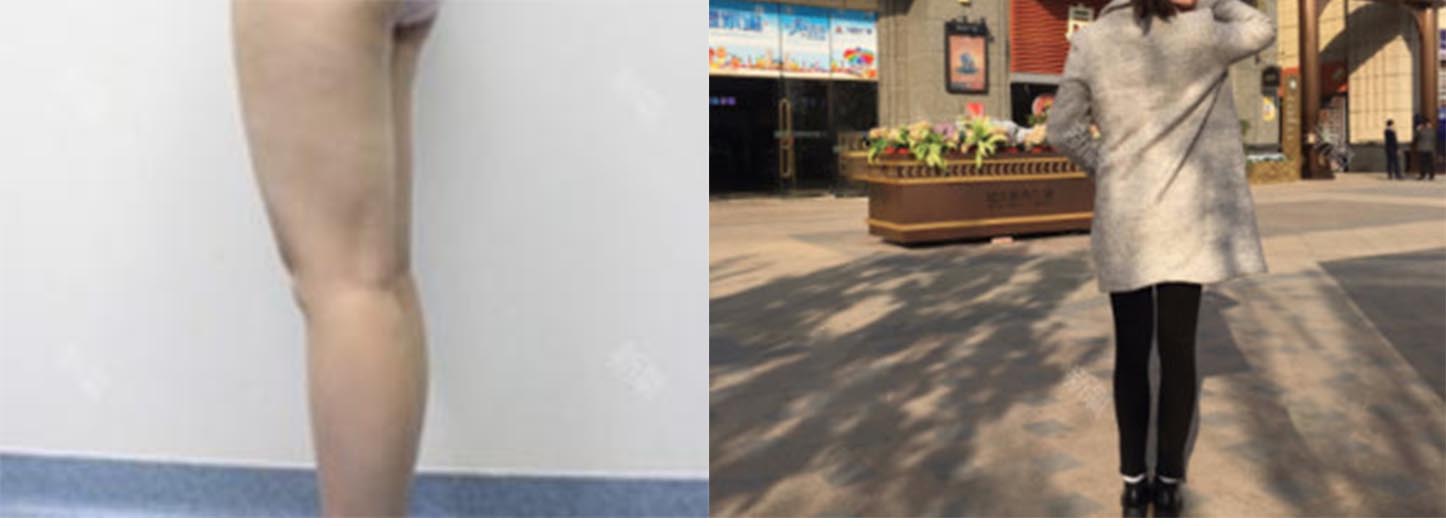 太原時(shí)光整形大腿吸脂術(shù)前術(shù)后效果圖