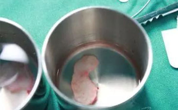 自體軟骨隆鼻是取自身體的那個部位？哪個部位的軟骨隆鼻效果更好