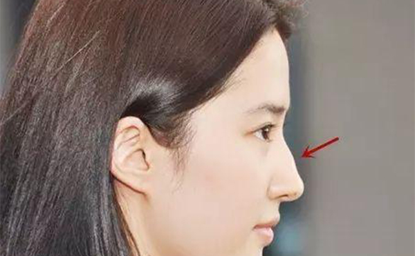 駝峰鼻要怎么改善？