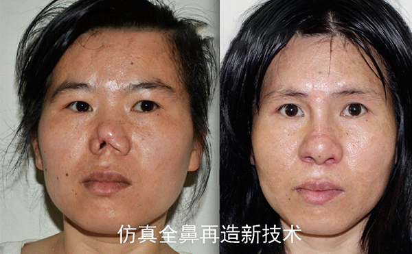 怎么做鼻再造手術(shù)?鼻再造的過程是怎樣的