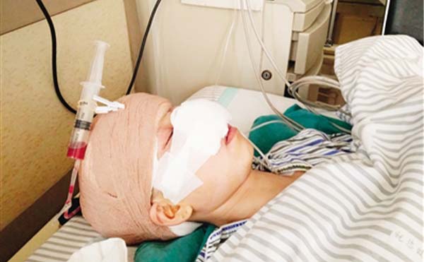 取鼻假體要重點(diǎn)注意什么