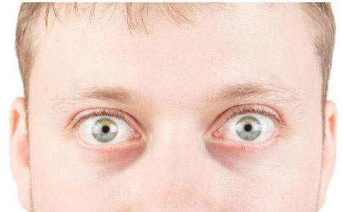 眼球突出可以矯正嗎？眼球突出矯正價(jià)格是多少