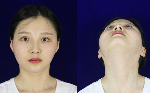 北京聯(lián)合麗格下頜角整形案例術(shù)前效果