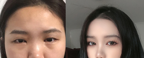 蘭州亞韓做雙眼皮案例對(duì)比圖3
