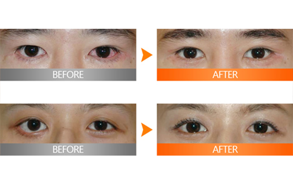 埋線雙眼皮失敗該如何修復(fù)？多久修復(fù)好？