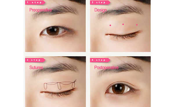韓式三點雙眼皮的優(yōu)點是什么?術(shù)后怎么避免不對稱?