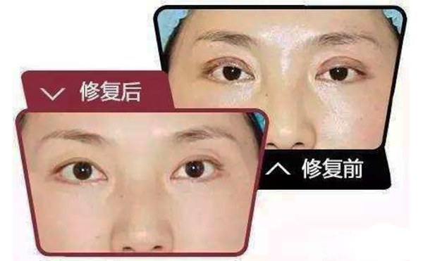 哪些情況需做雙眼皮修復(fù)？修復(fù)難度大不大?