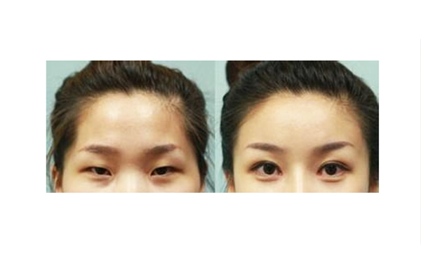 先天性小眼癥怎么矯正?有哪些注意事項?