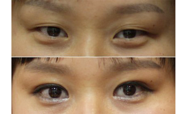 哪些人不能做小眼矯正?矯正術(shù)前有什么注意事項(xiàng)?