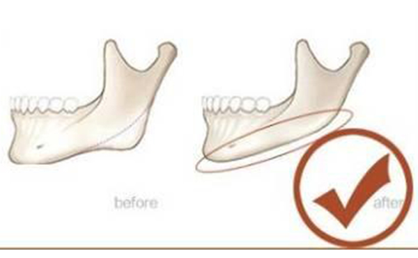 顱頜面整形術(shù)前要注意什么?