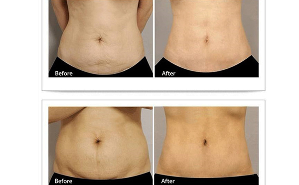 腹壁成型術(shù)會(huì)留疤嗎？