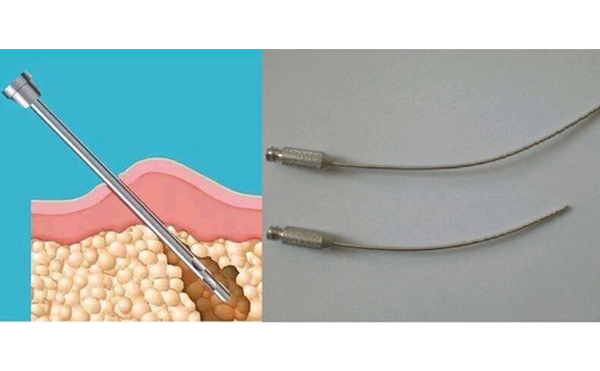 面部吸脂效果怎么樣?術(shù)后會不會留疤?