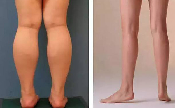 腿部吸脂疼不疼？