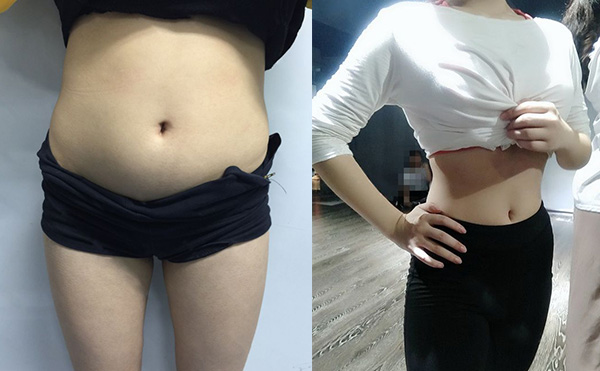 環(huán)吸抽脂有什么優(yōu)勢？