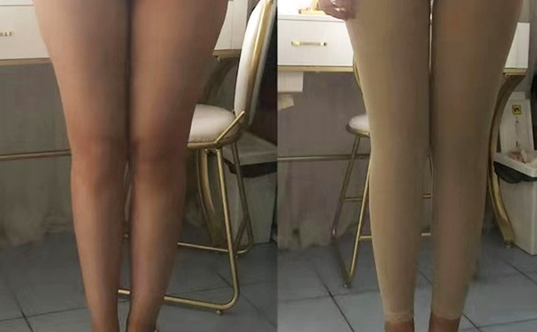 環(huán)吸抽脂疼不疼？