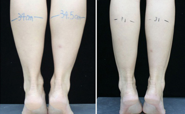 瘦腿針可以維持多長時間？