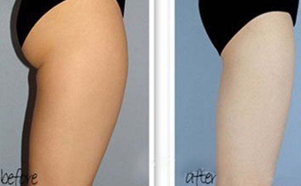 哪些人適合做臀部抽脂？