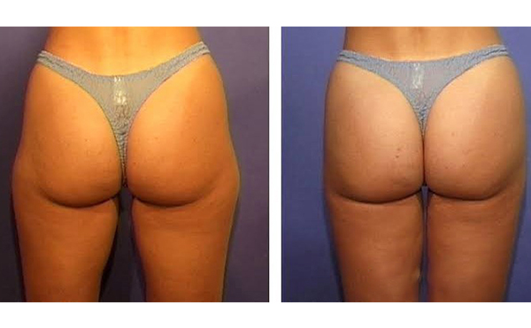 臀部吸脂一次最多能吸多少?術(shù)后需要多久恢復(fù)?