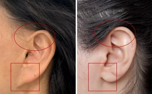 拉皮手術(shù)的危害有哪些?術(shù)前要注意什么?