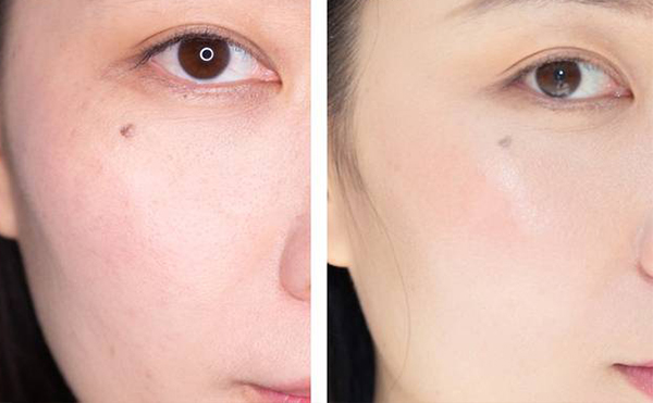 電波拉皮有哪些優(yōu)勢?做電波拉皮需要注意什么?