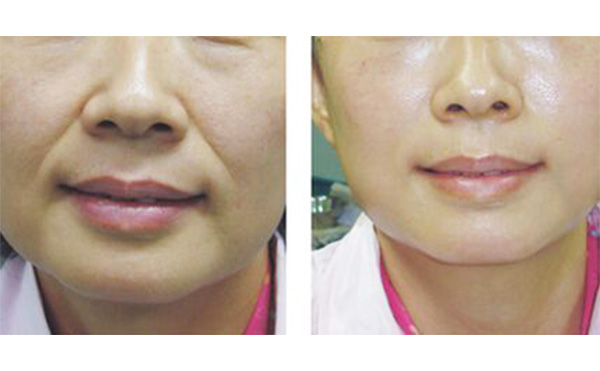 法令紋怎么去除效果好?如何選擇?