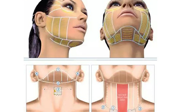 超聲刀怎么祛除頸紋？
