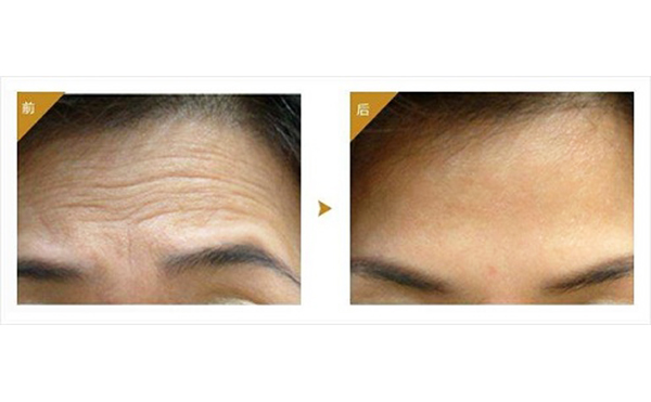 注射玻尿酸注意事項有哪些？