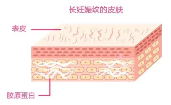 妊娠紋是怎么形成的？