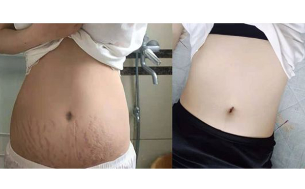 激光可以去除妊娠紋嗎？