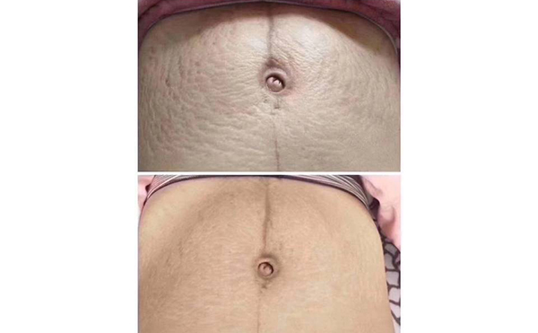 激光去妊辰紋多少錢？