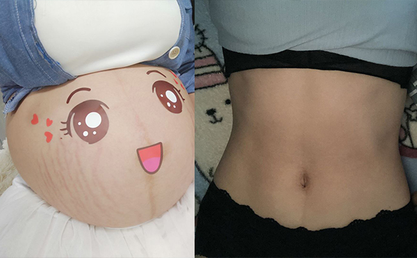 電波拉皮去除妊娠紋效果怎么樣？