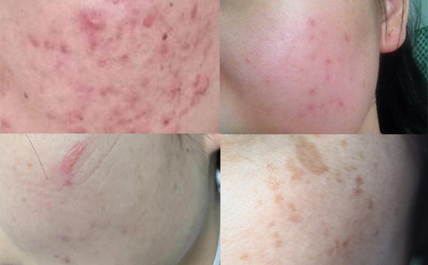 光子嫩膚安全嗎？