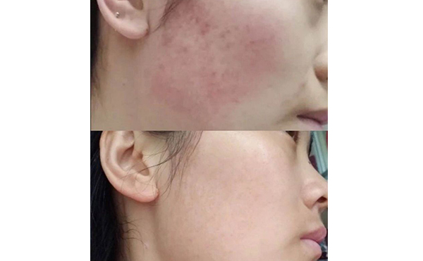 彩光嫩膚會(huì)讓皮膚變薄嗎？