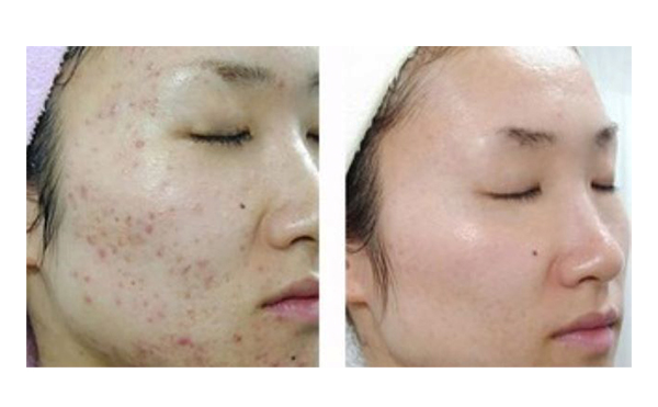 果酸煥膚多久做一次？