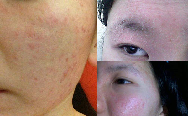 果酸煥膚安全嗎？