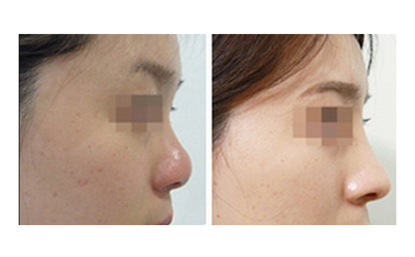 美白針和激光美白怎么選？