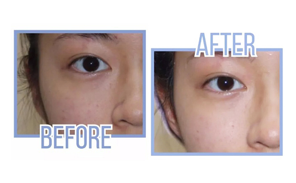 激光美白做幾次有效果？